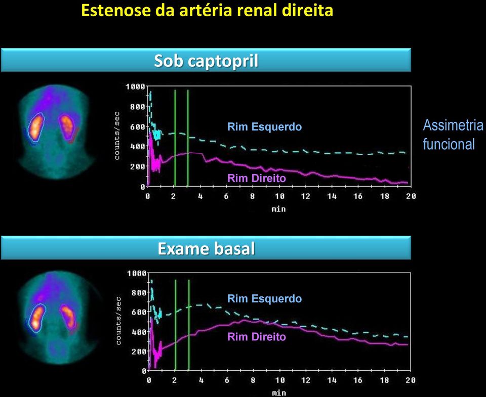 Esquerdo Assimetria funcional