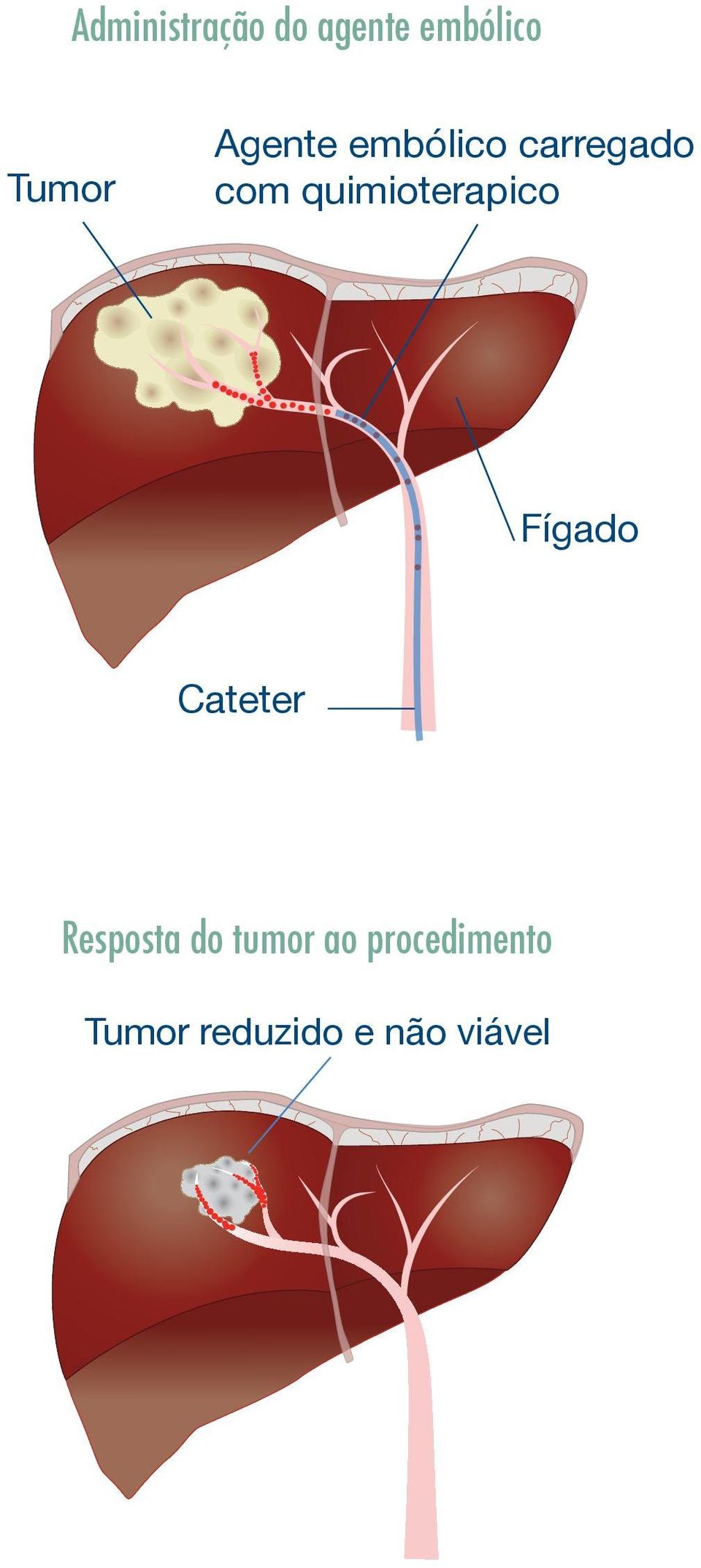 quimioterapico Fígado Cateter Resposta