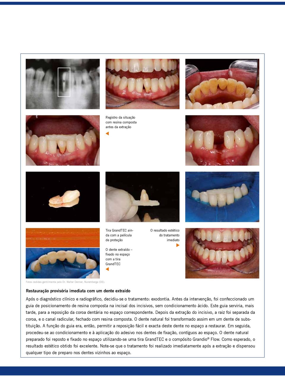 Restauração provisória imediata com um dente extraído Após o diagnóstico clínico e radiográfico, decidiu-se o tratamento: exodontia.