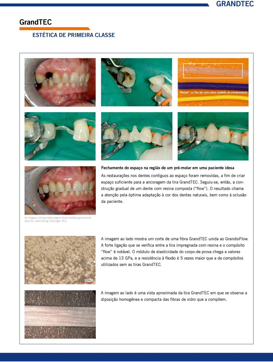 O resultado chama a atenção pela óptima adaptação à cor dos dentes naturais, bem como à oclusão da paciente. As imagens clínicas desta página foram cedidas gentilmente pelo Drs.