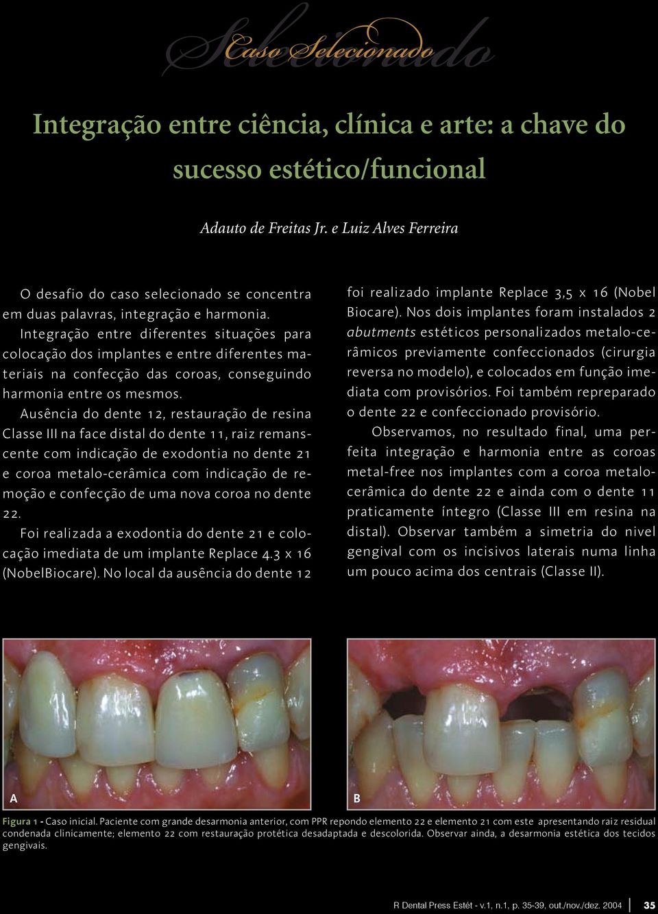 Integração entre diferentes situações para colocação dos implantes e entre diferentes materiais na confecção das coroas, conseguindo harmonia entre os mesmos.