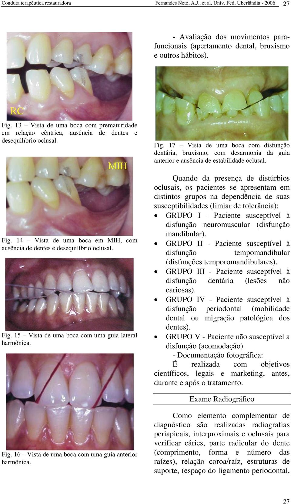 Fig. 17 Vista de uma boca com disfunção dentária, bruxismo, com desarmonia da guia anterior e ausência de estabilidade oclusal.