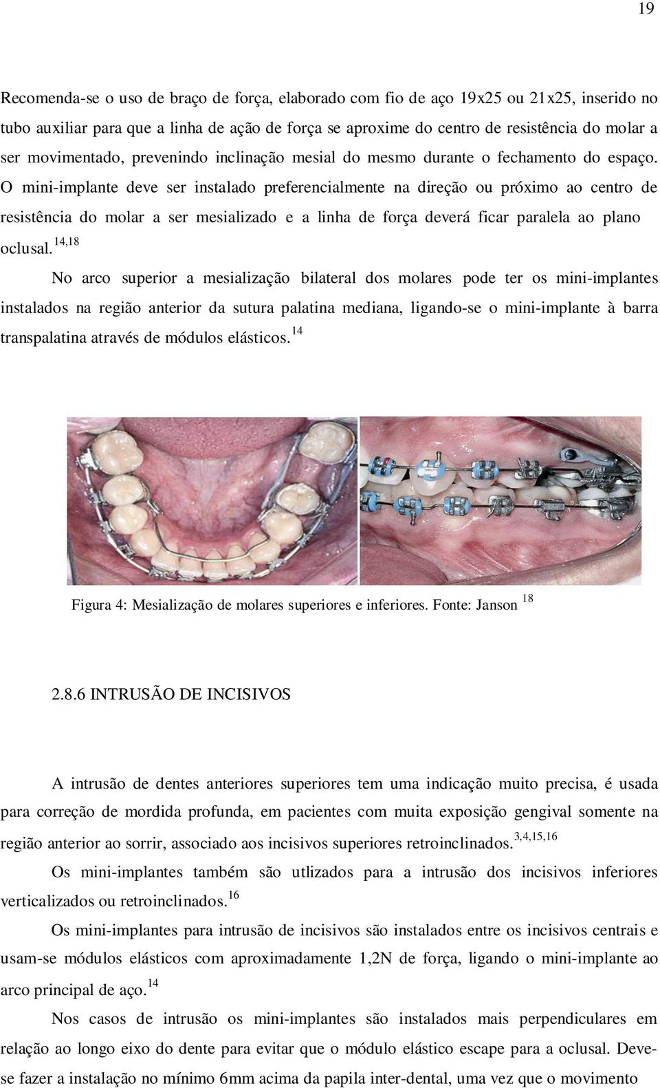 O mini-implante deve ser instalado preferencialmente na direção ou próximo ao centro de resistência do molar a ser mesializado e a linha de força deverá ficar paralela ao plano oclusal.