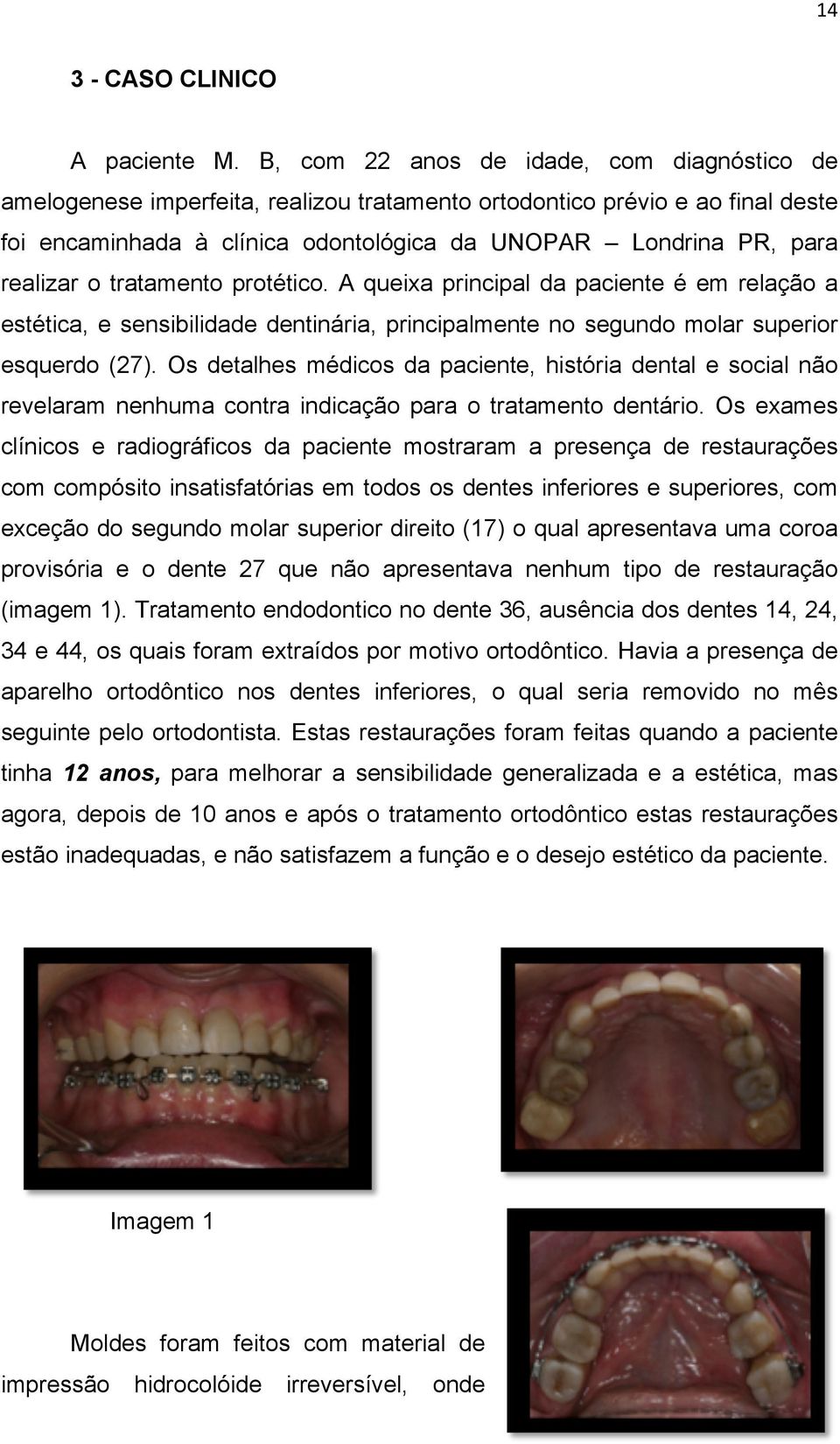 o tratamento protético. A queixa principal da paciente é em relação a estética, e sensibilidade dentinária, principalmente no segundo molar superior esquerdo (27).