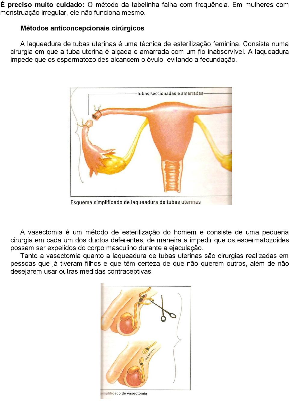 A laqueadura impede que os espermatozoides alcancem o óvulo, evitando a fecundação.