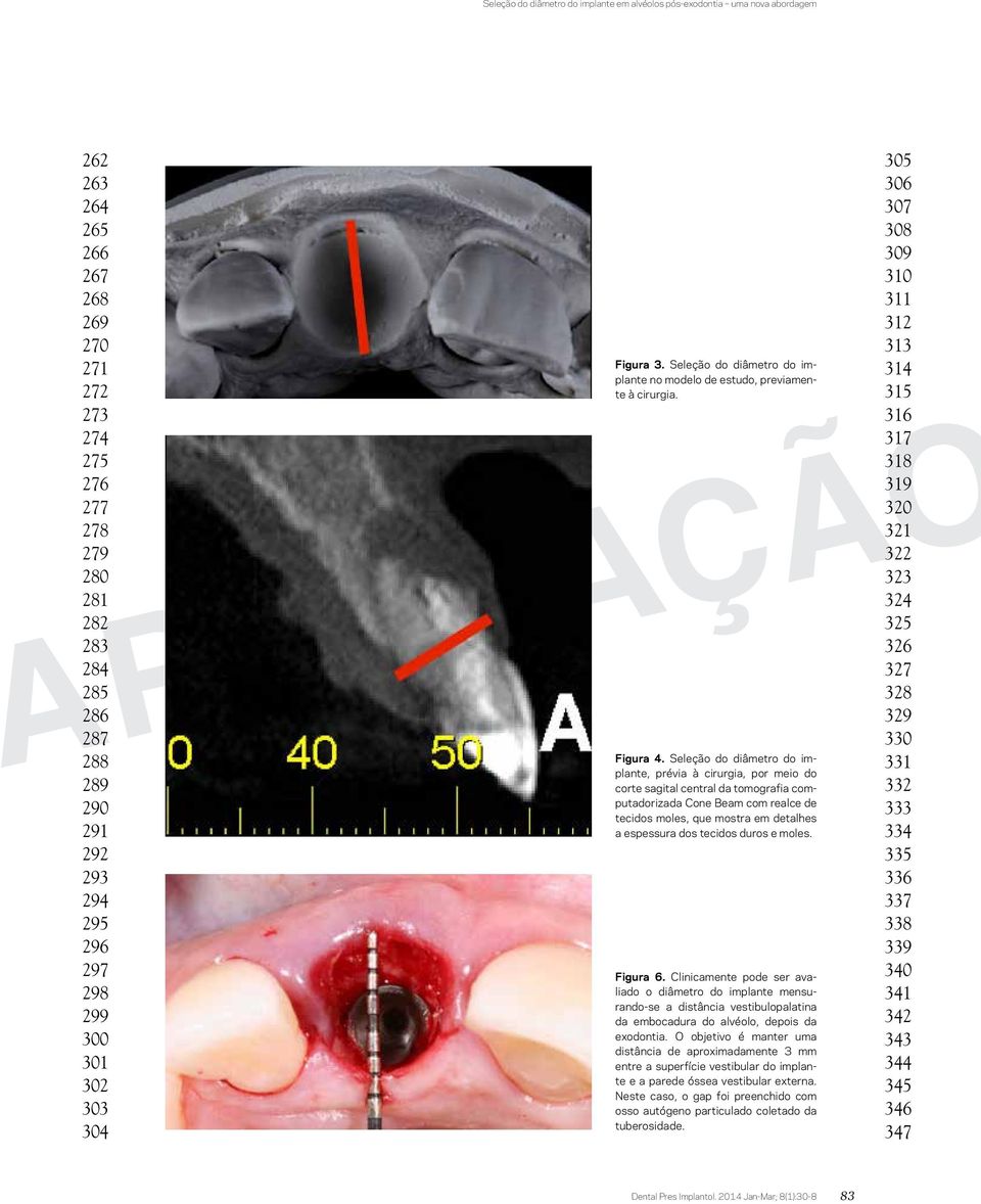 Seleção do diâmetro do implante, prévia à cirurgia, por meio do corte sagital central da tomografia computadorizada Cone Beam com realce de tecidos moles, que mostra em detalhes a espessura dos
