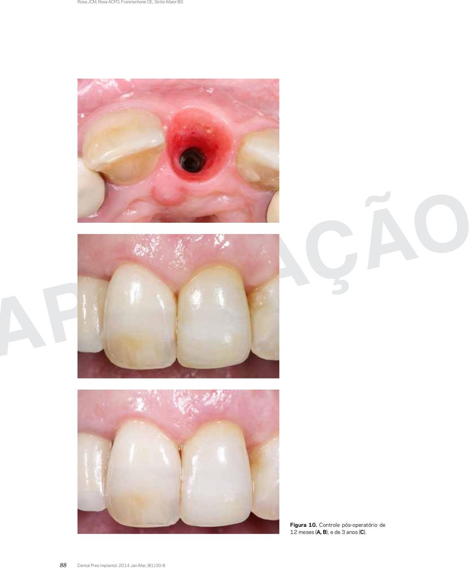 Controle pós-operatório de 12 meses (A, B),