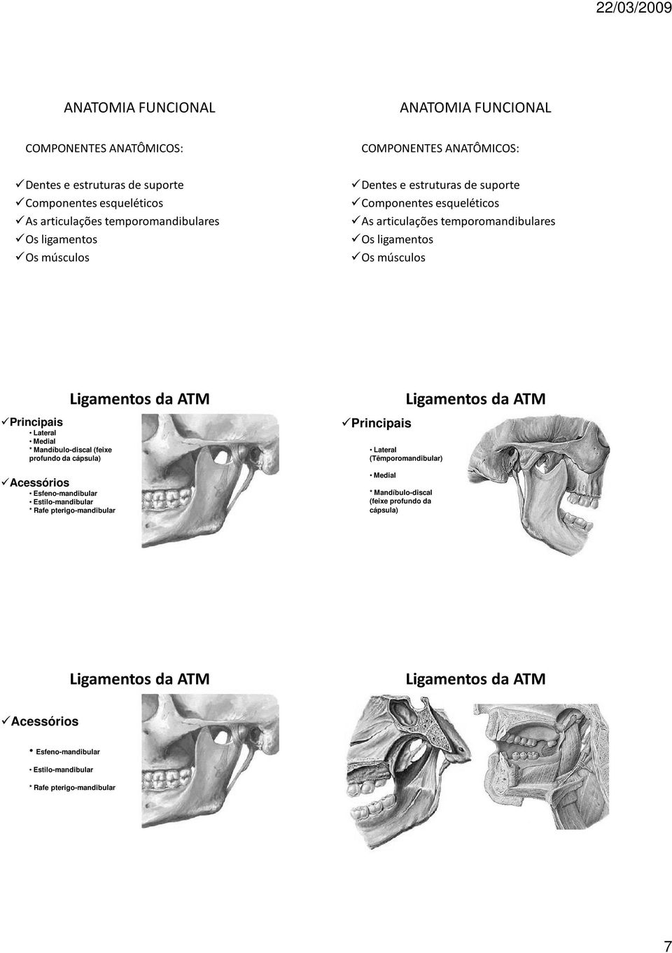 Ligamentos da ATM Lateral (Têmporomandibular) Medial * Mandíbulo-discal (feixe profundo da