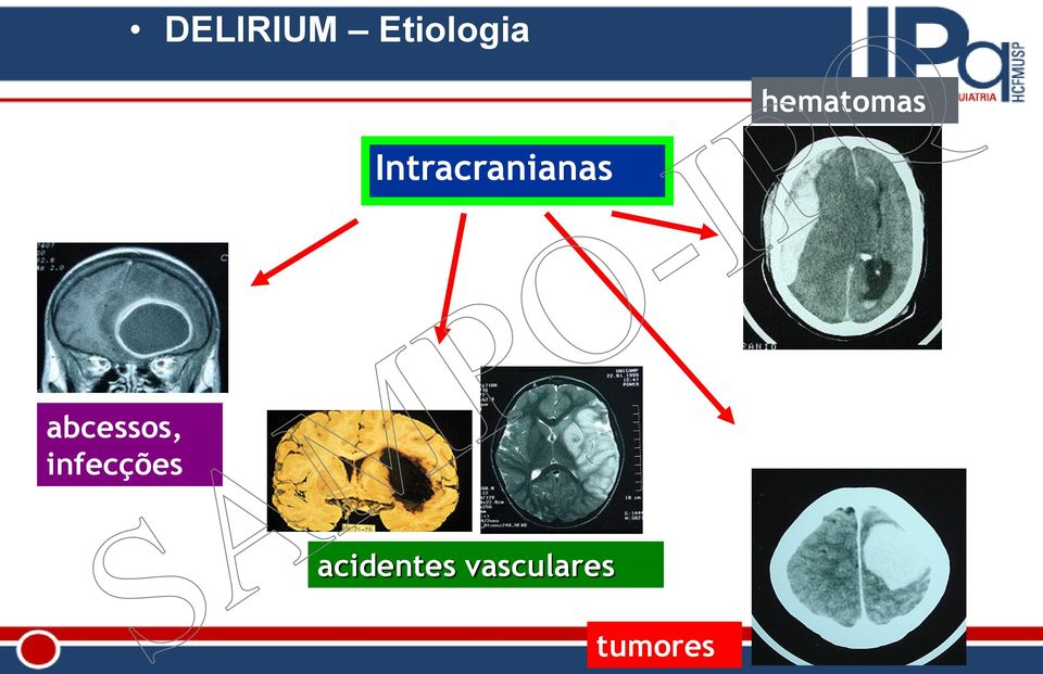 Intracranianas