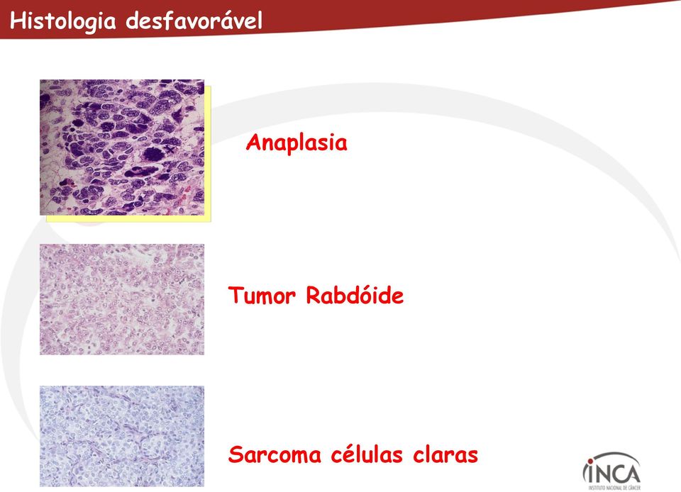 Anaplasia Tumor