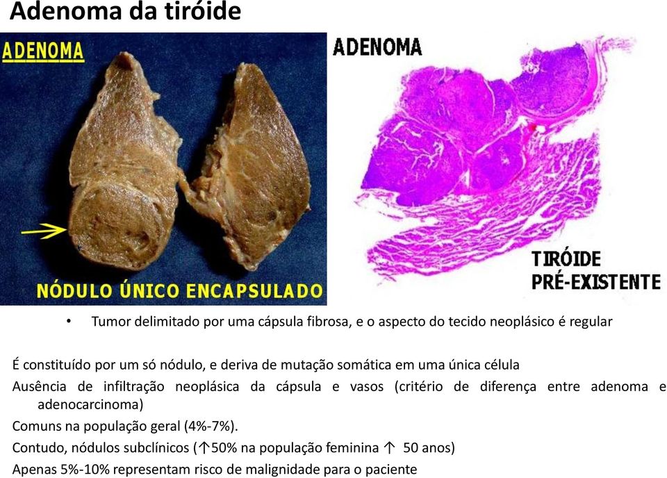 da cápsula e vasos (critério de diferença entre adenoma e adenocarcinoma) Comuns na população geral (4%-7%).