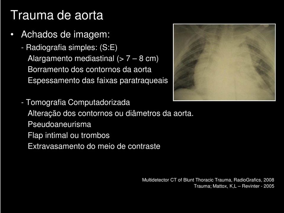 Alteração dos contornos ou diâmetros da aorta.