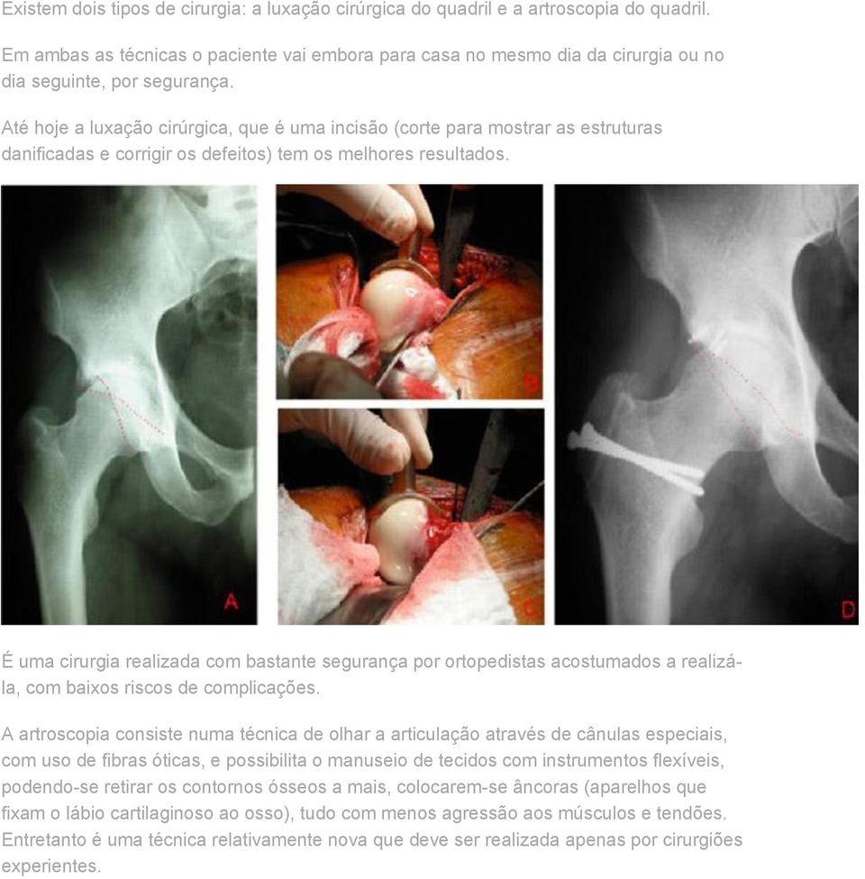 Até hoje a luxação cirúrgica, que é uma incisão (corte para mostrar as estruturas danificadas e corrigir os defeitos) tem os melhores resultados.