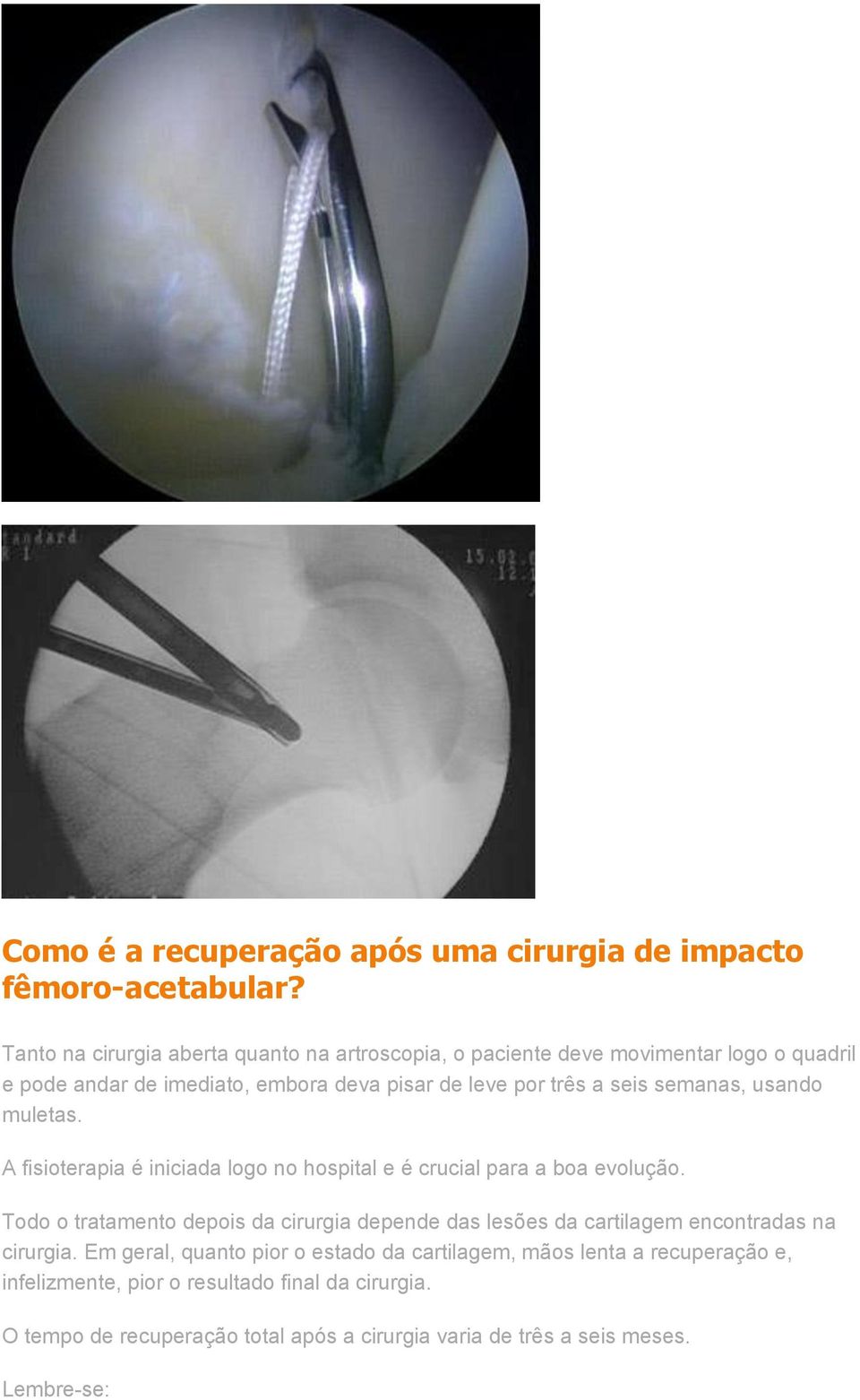 semanas, usando muletas. A fisioterapia é iniciada logo no hospital e é crucial para a boa evolução.