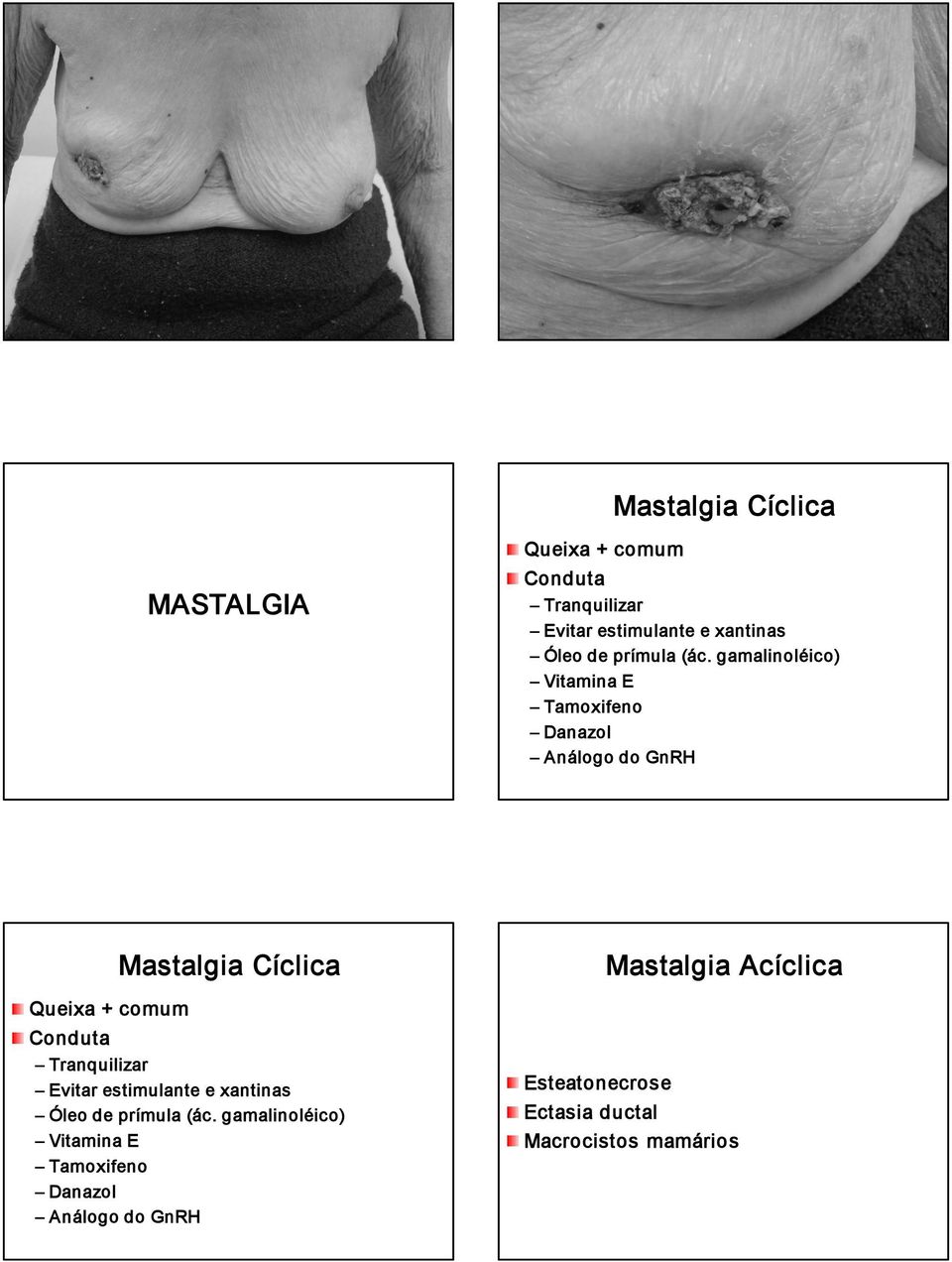 gamalinoléico) Vitamina E Tamoxifeno Danazol Análogo do GnRH Queixa + comum Tranquilizar Mastalgia
