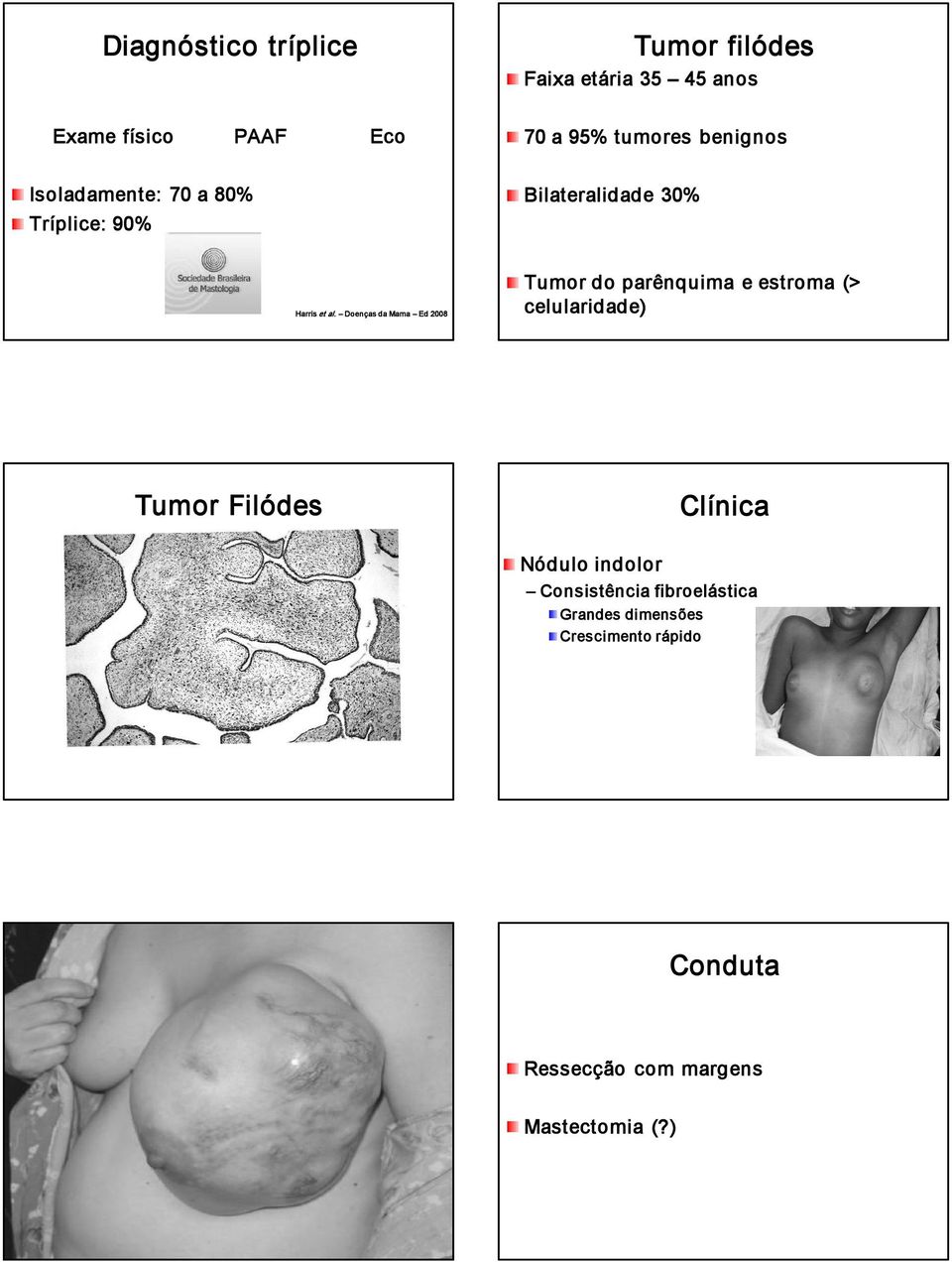 Doenças da Mama Ed 2008 Tumor do parênquima e estroma (> celularidade) Tumor Filódes Clínica