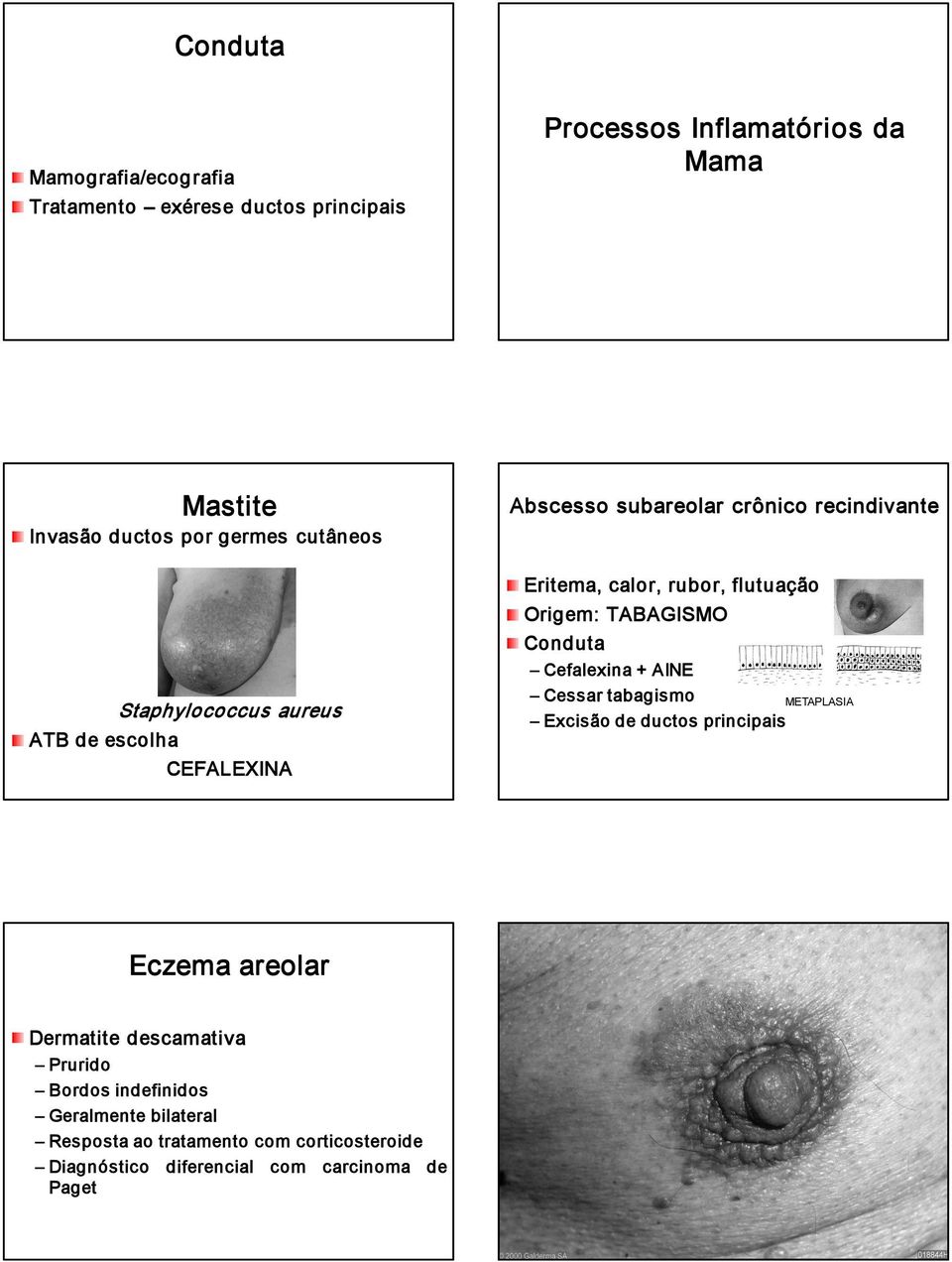 Origem: TABAGISMO Cefalexina + AINE Cessar tabagismo Excisão de ductos principais METAPLASIA Eczema areolar Dermatite descamativa