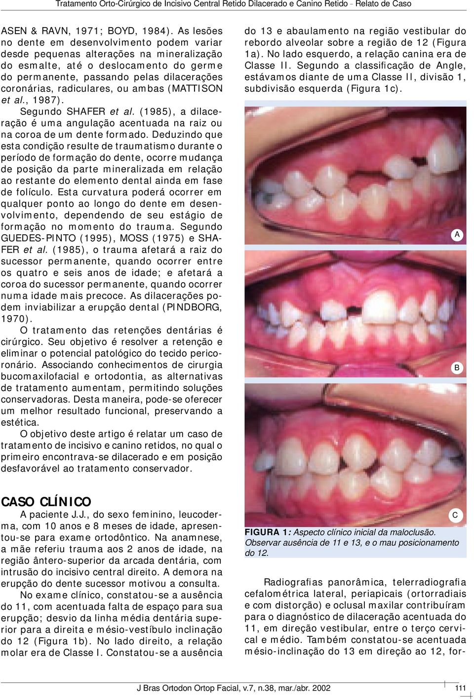 radiculares, ou ambas (MATTISON et al., 1987). Segundo SHAFER et al. (1985), a dilaceração é uma angulação acentuada na raiz ou na coroa de um dente formado.