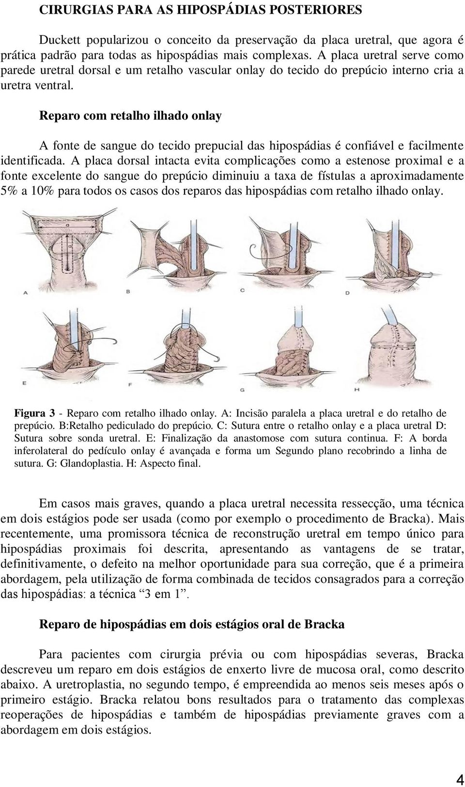 Reparo com retalho ilhado onlay A fonte de sangue do tecido prepucial das hipospádias é confiável e facilmente identificada.