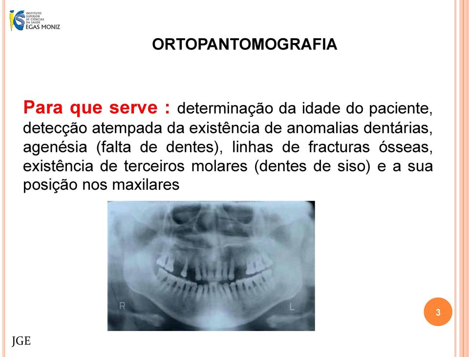 agenésia (falta de dentes), linhas de fracturas ósseas,