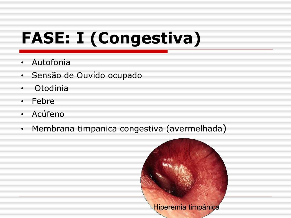 Febre Acúfeno Membrana timpanica