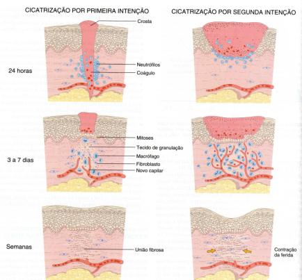 Cicatrização por Primeira Intenção Quando existe aposição das bordas da ferida cirúrgica quase sem deixar solução de continuidade.