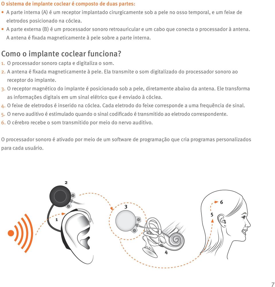 Como o implante coclear funciona? 1. O processador sonoro capta e digitaliza o som. 2. A antena é fixada magneticamente à pele.