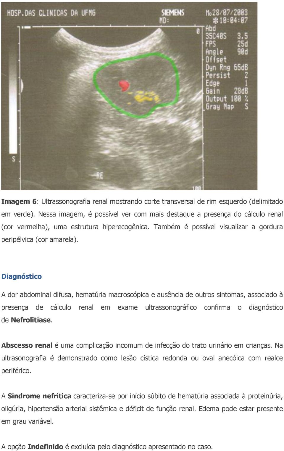 Diagnóstico A dor abdominal difusa, hematúria macroscópica e ausência de outros sintomas, associado à presença de cálculo renal em exame ultrassonográfico confirma o diagnóstico de Nefrolitíase.