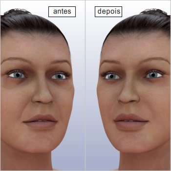 Recuperação do lifting facial do terço médio Embora alguns médicos prefiram não utilizar curativos, outros podem aplicar uma bandagem mais frouxa ou uma malha de compressão para agilizar o processo