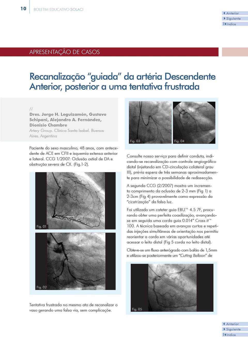 CCG 1/2007: Oclusão ostial de DA e obstrução severa de CX. (Fig.1-2). Fig. 01 Fig. 03 Fig.