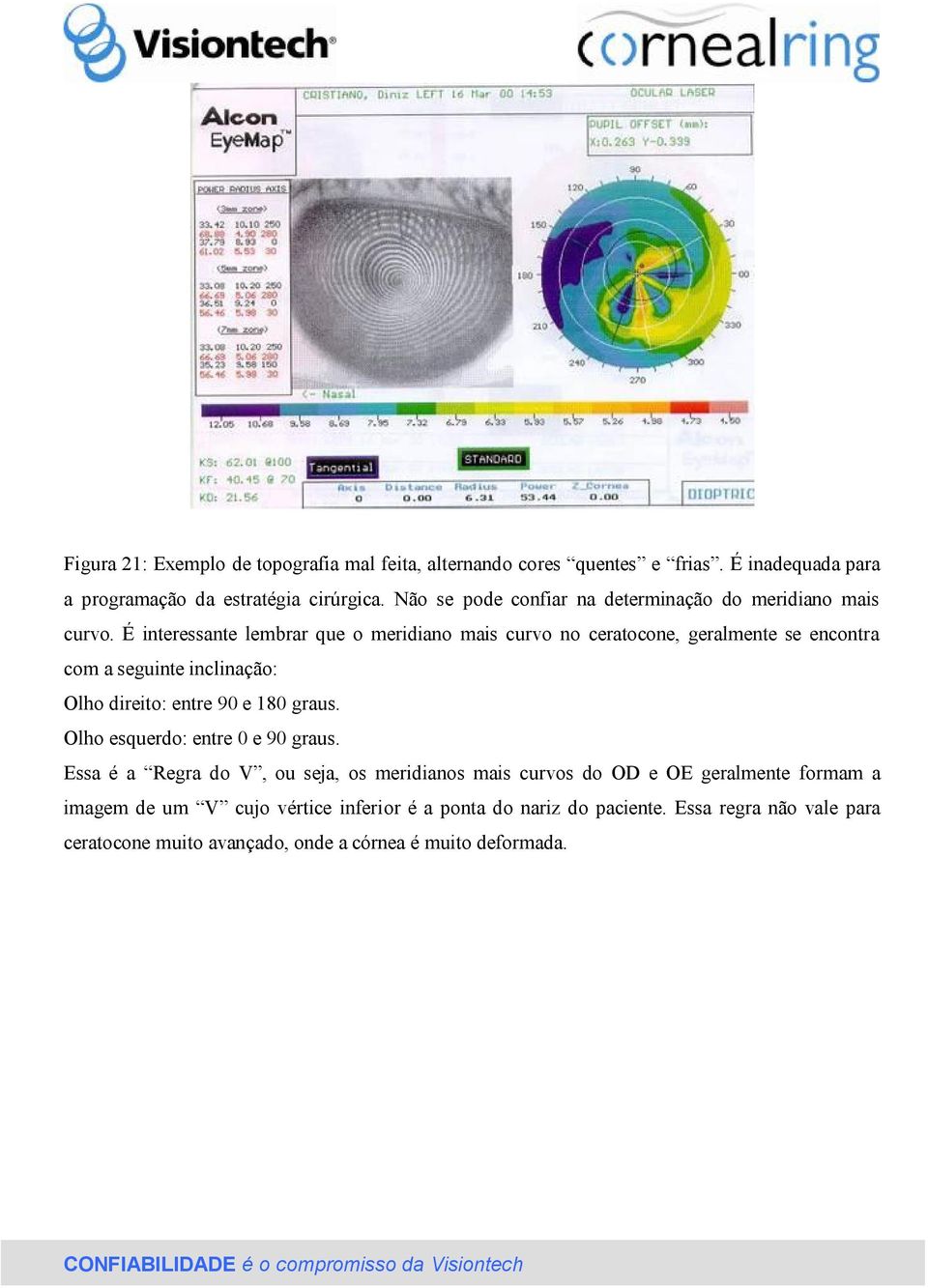 É interessante lembrar que o meridiano mais curvo no ceratocone, geralmente se encontra com a seguinte inclinação: Olho direito: entre 90 e 180 graus.