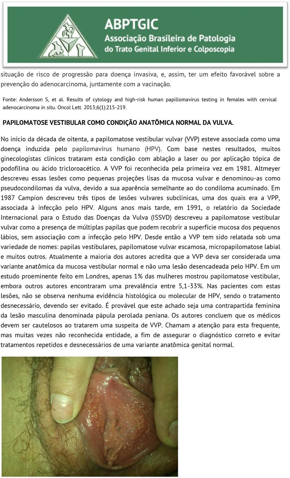 PAPILOMATOSE VESTIBULAR COMO CONDIÇÃO ANATÔMICA NORMAL DA VULVA.