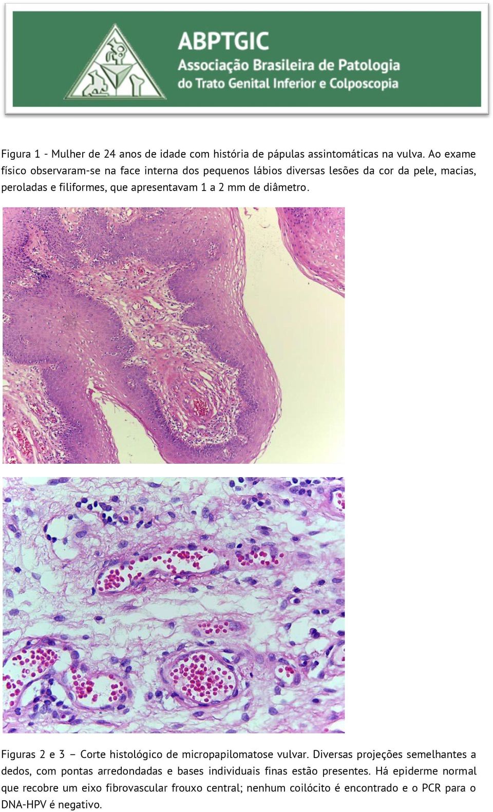 apresentavam 1 a 2 mm de diâmetro. Figuras 2 e 3 Corte histológico de micropapilomatose vulvar.