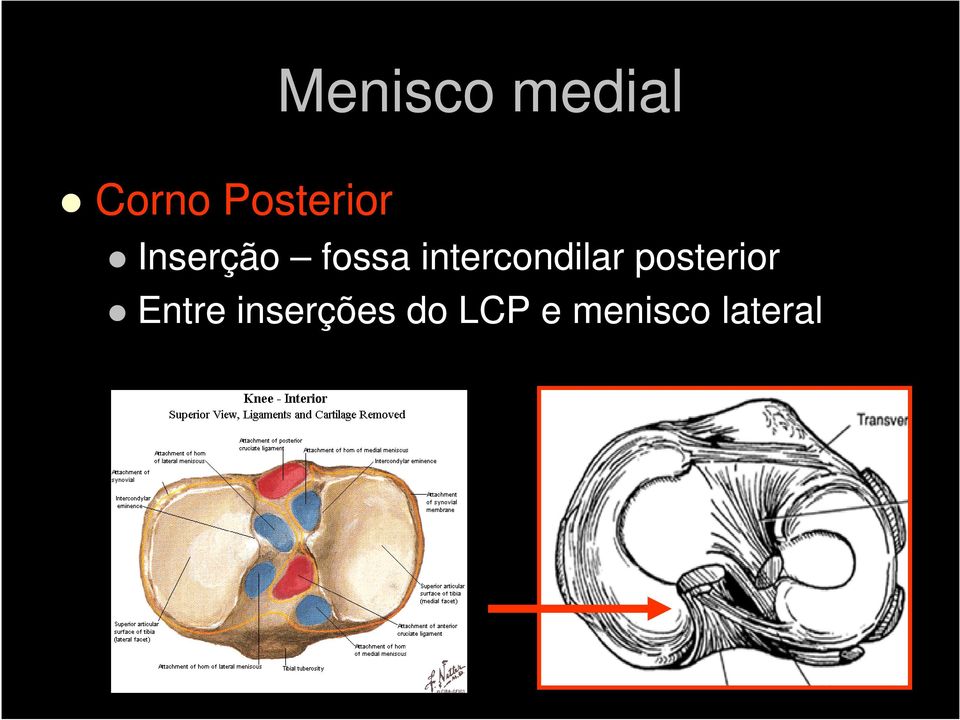 intercondilar posterior