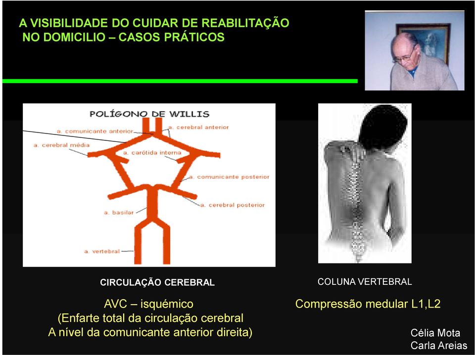 (Enfarte total da circulação cerebral A nível da