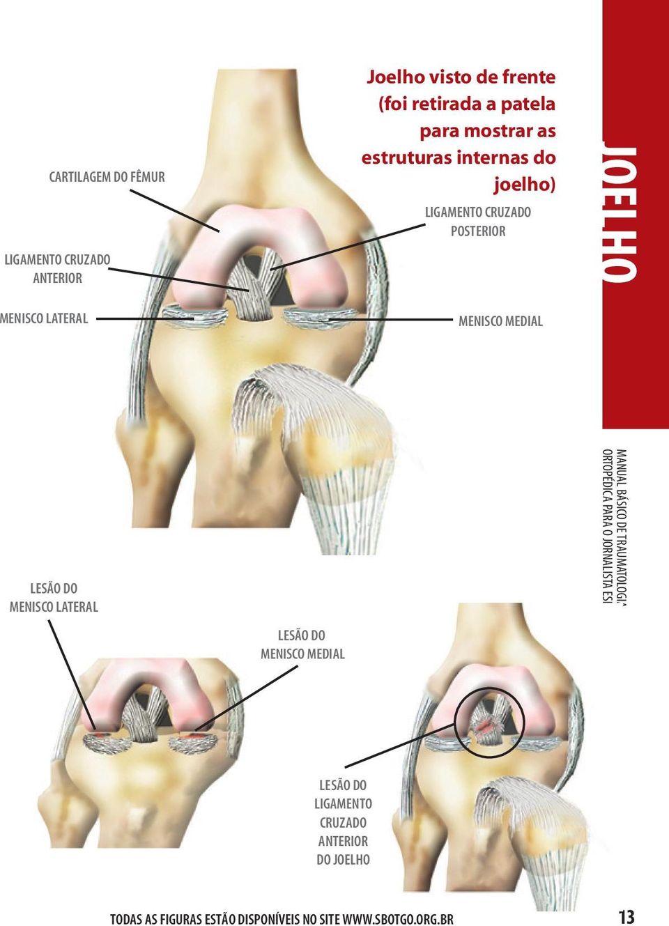 LIGAMENTO CRUZADO POSTERIOR MENISCO MEDIAL LESÃO DO MENISCO LATERAL LESÃO DO MENISCO MEDIAL LESÃO DO