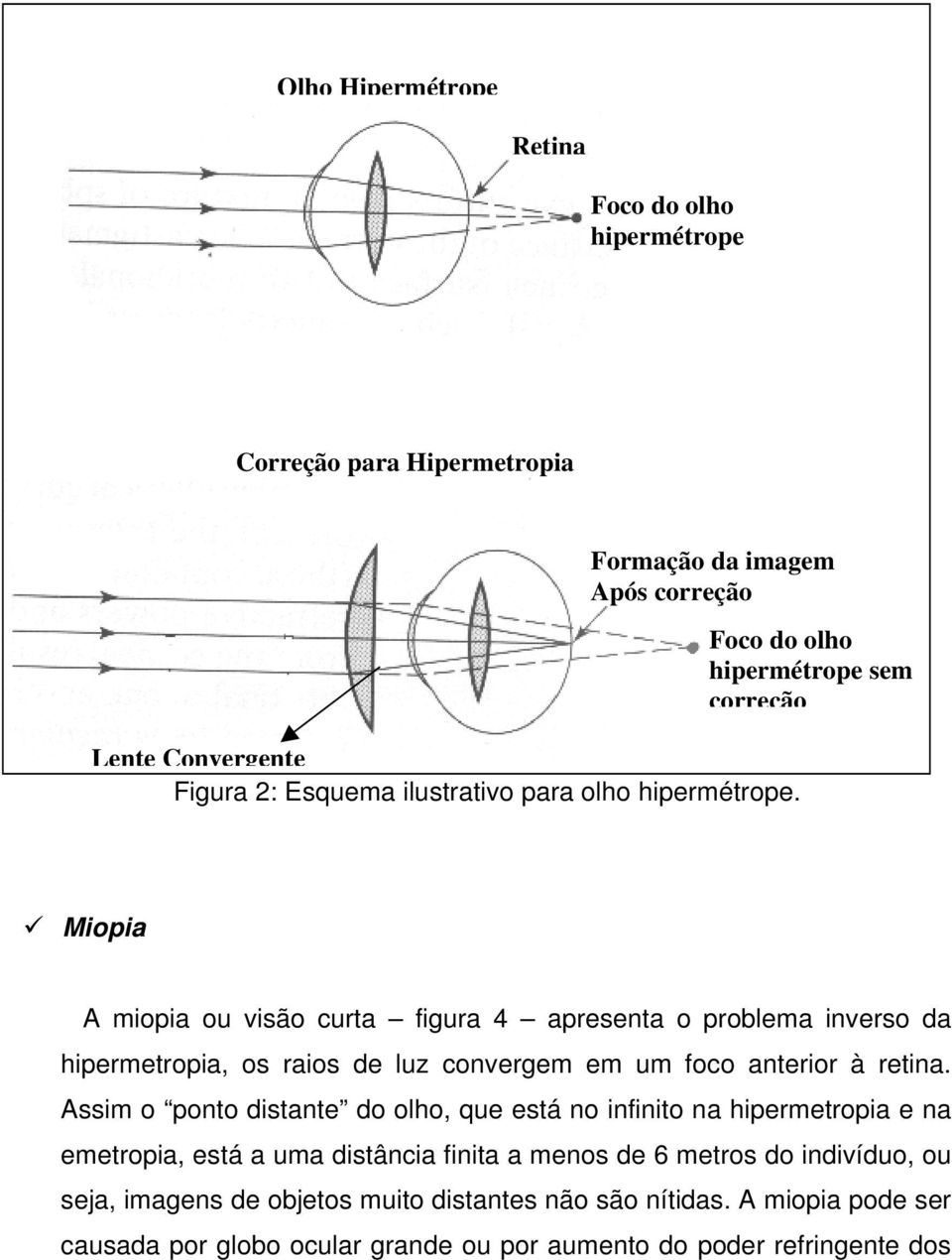 Foco do olho hipermétrope sem correção Miopia A miopia ou visão curta figura 4 apresenta o problema inverso da hipermetropia, os raios de luz convergem em um foco