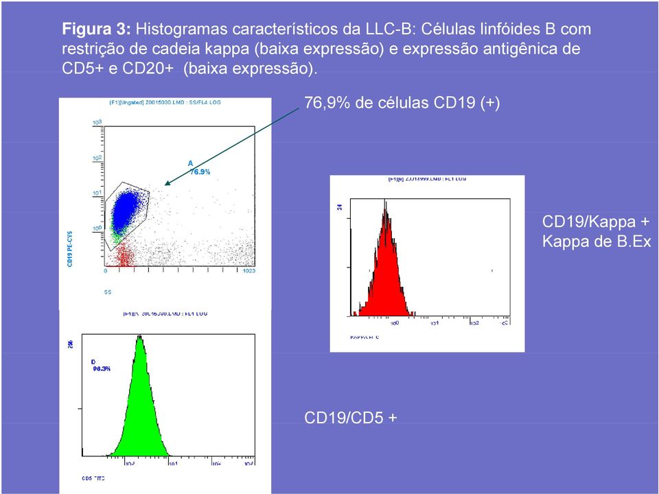 e expressão antigênica de CD5+ e CD20+ (baixa expressão).