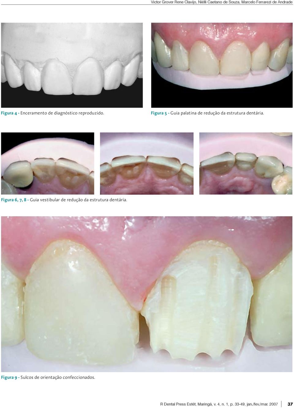 Figura 5 - Guia palatina de redução da estrutura dentária.