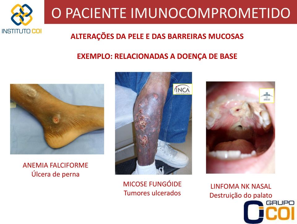 BASE ANEMIA FALCIFORME Úlcera de perna MICOSE