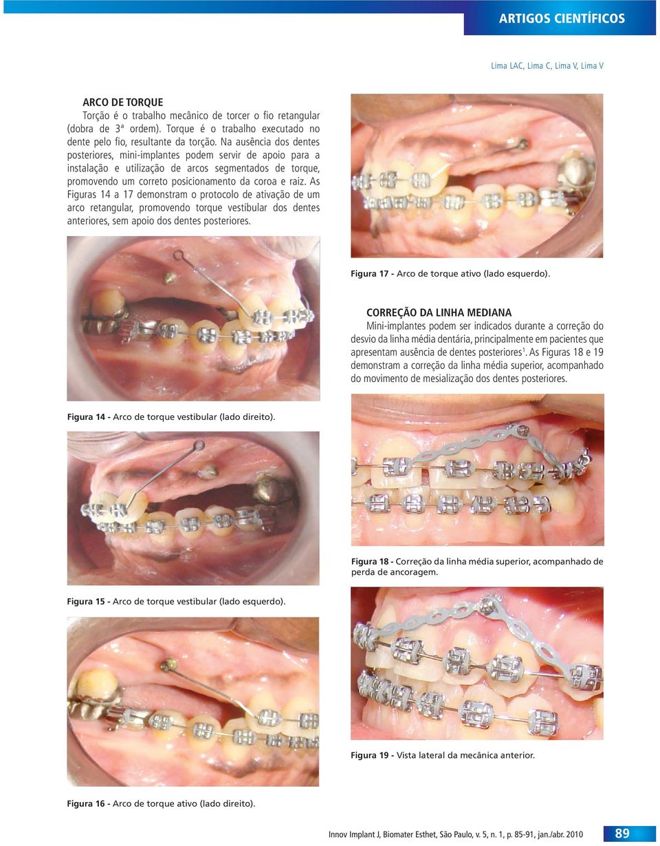 As Figuras 14 a 17 demonstram o protocolo de ativação de um arco retangular, promovendo torque vestibular dos dentes anteriores, sem apoio dos dentes posteriores.