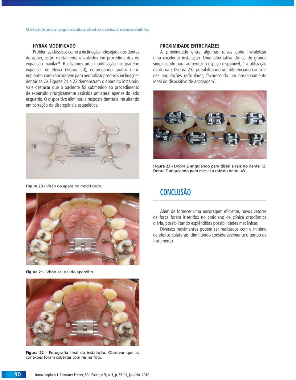 Realizamos uma modifi cação no aparelho expansor de Hyrax (Figura 20), empregando quatro miniimplantes como ancoragem para neutralizar possíveis inclinações dentárias.