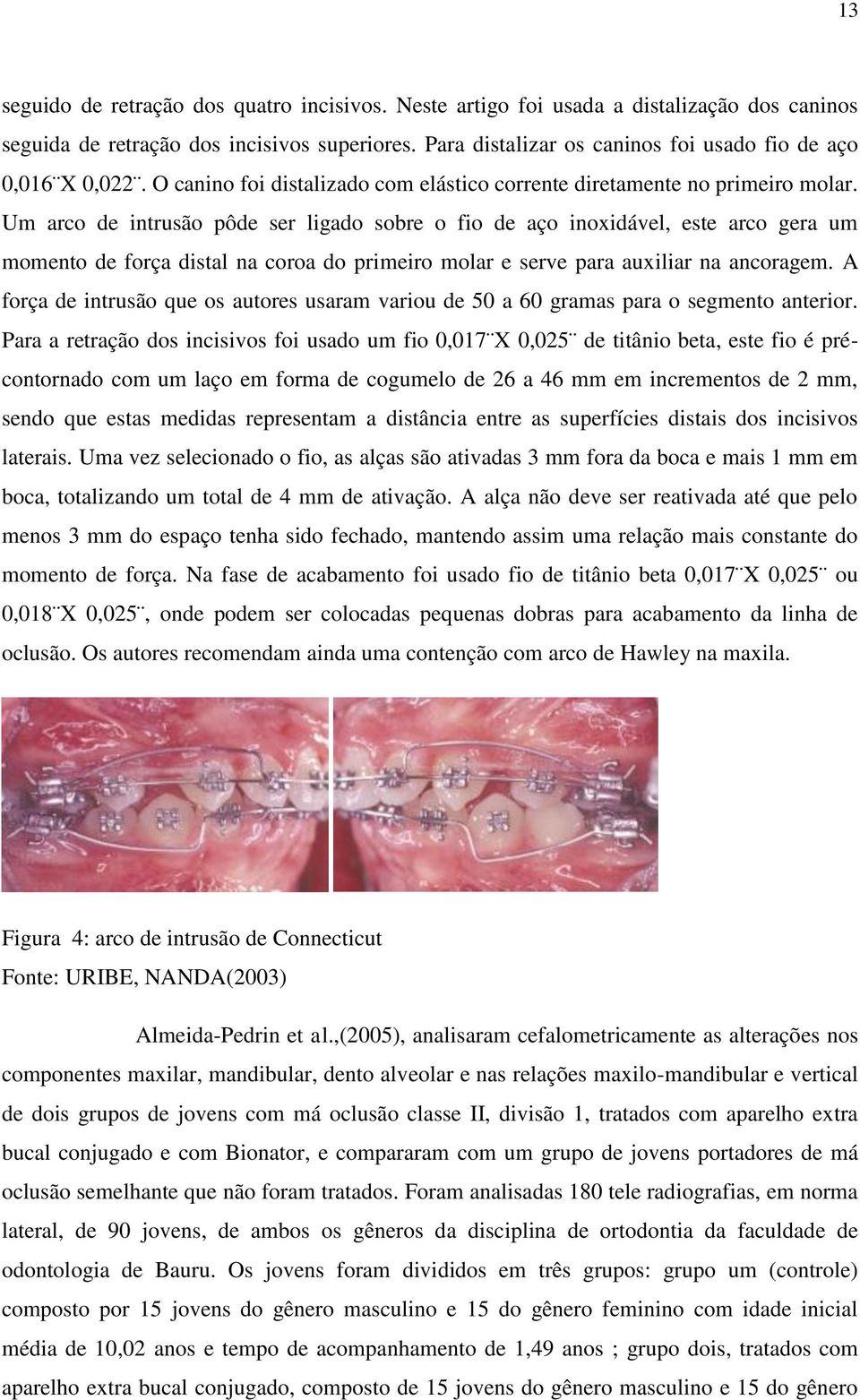 Um arco de intrusão pôde ser ligado sobre o fio de aço inoxidável, este arco gera um momento de força distal na coroa do primeiro molar e serve para auxiliar na ancoragem.