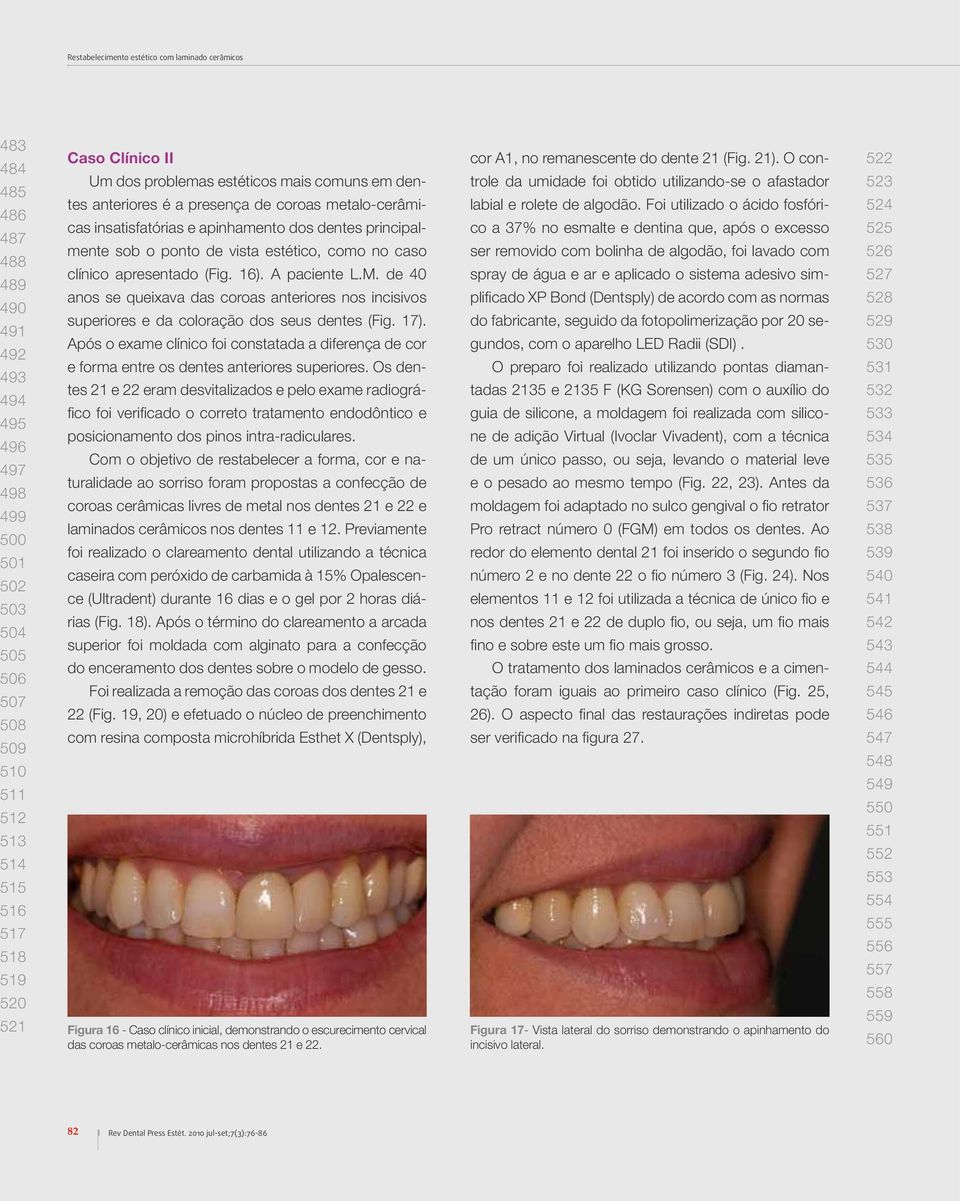 vista estético, como no caso clínico apresentado (Fig. 16). A paciente L.M. de 40 anos se queixava das coroas anteriores nos incisivos superiores e da coloração dos seus dentes (Fig. 17).