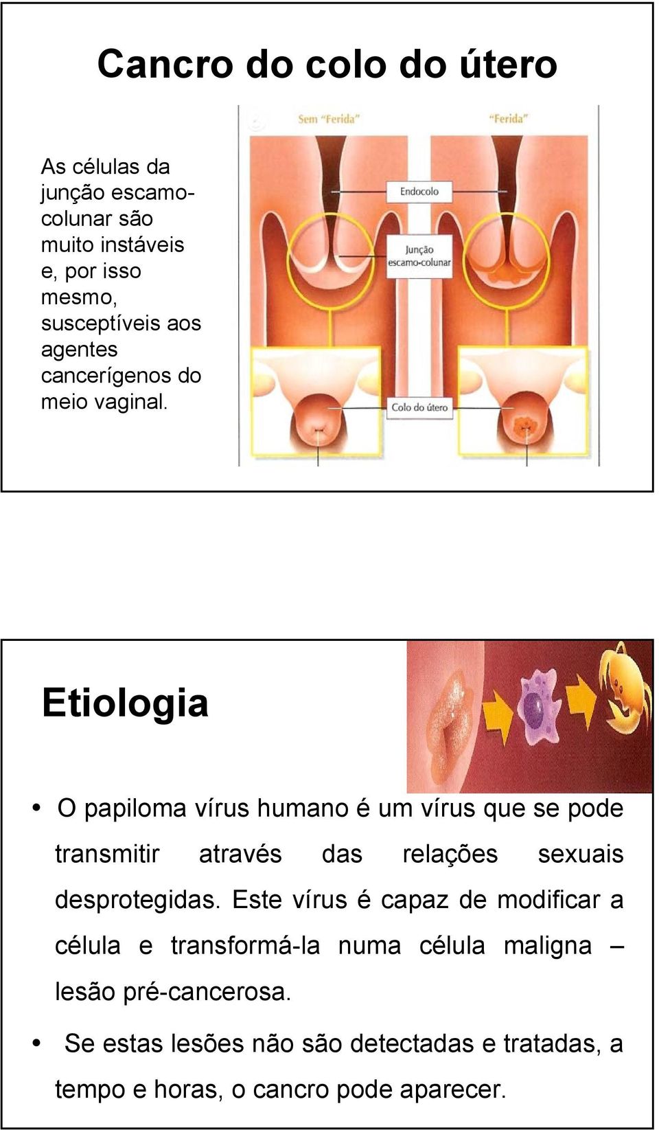 Etiologia O papiloma vírus humano é um vírus que se pode transmitir através das relações sexuais desprotegidas.