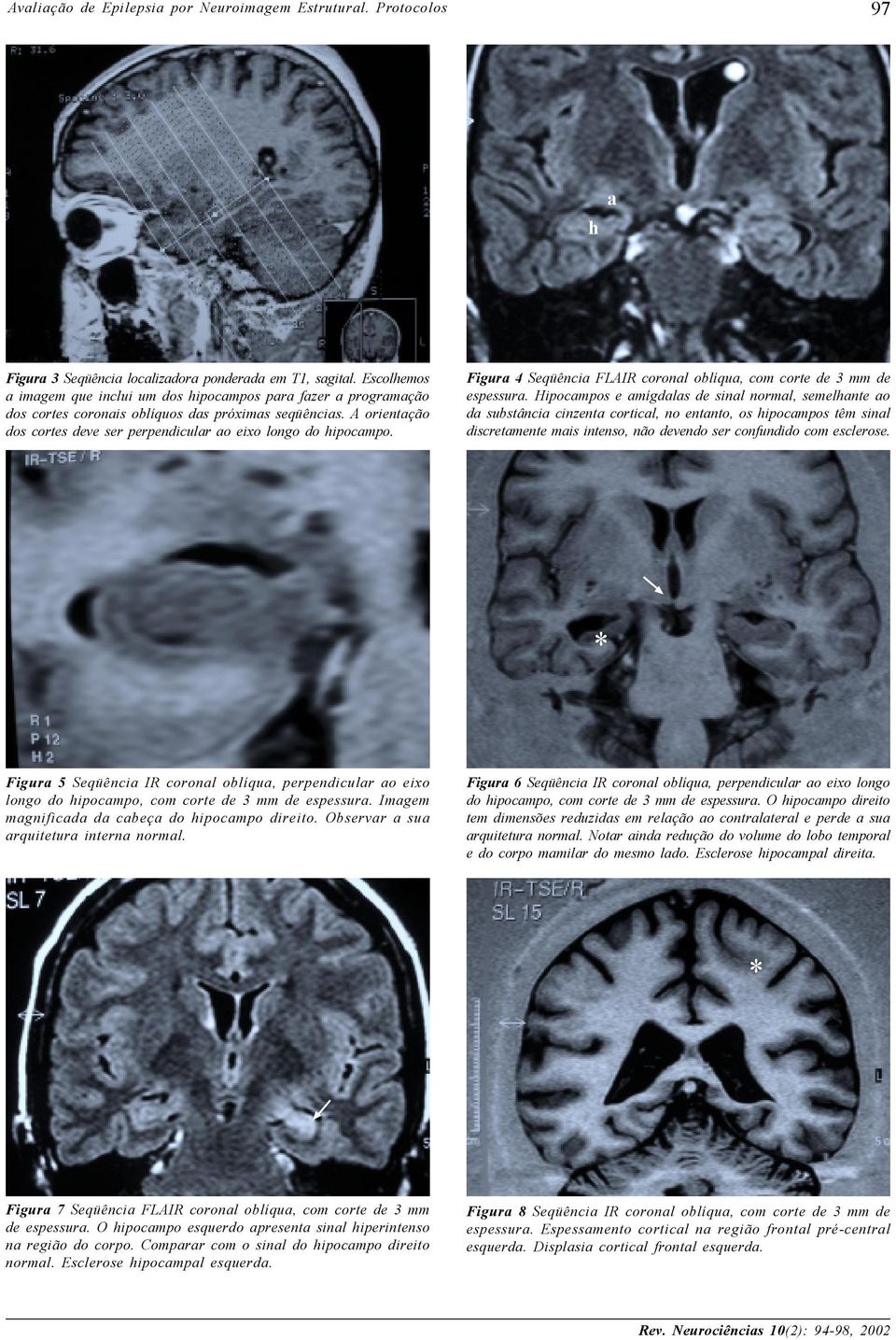 Hipocampos e amígdalas de sinal normal, semelhante ao da substância cinzenta cortical, no entanto, os hipocampos têm sinal discretamente mais intenso, não devendo ser confundido com esclerose.