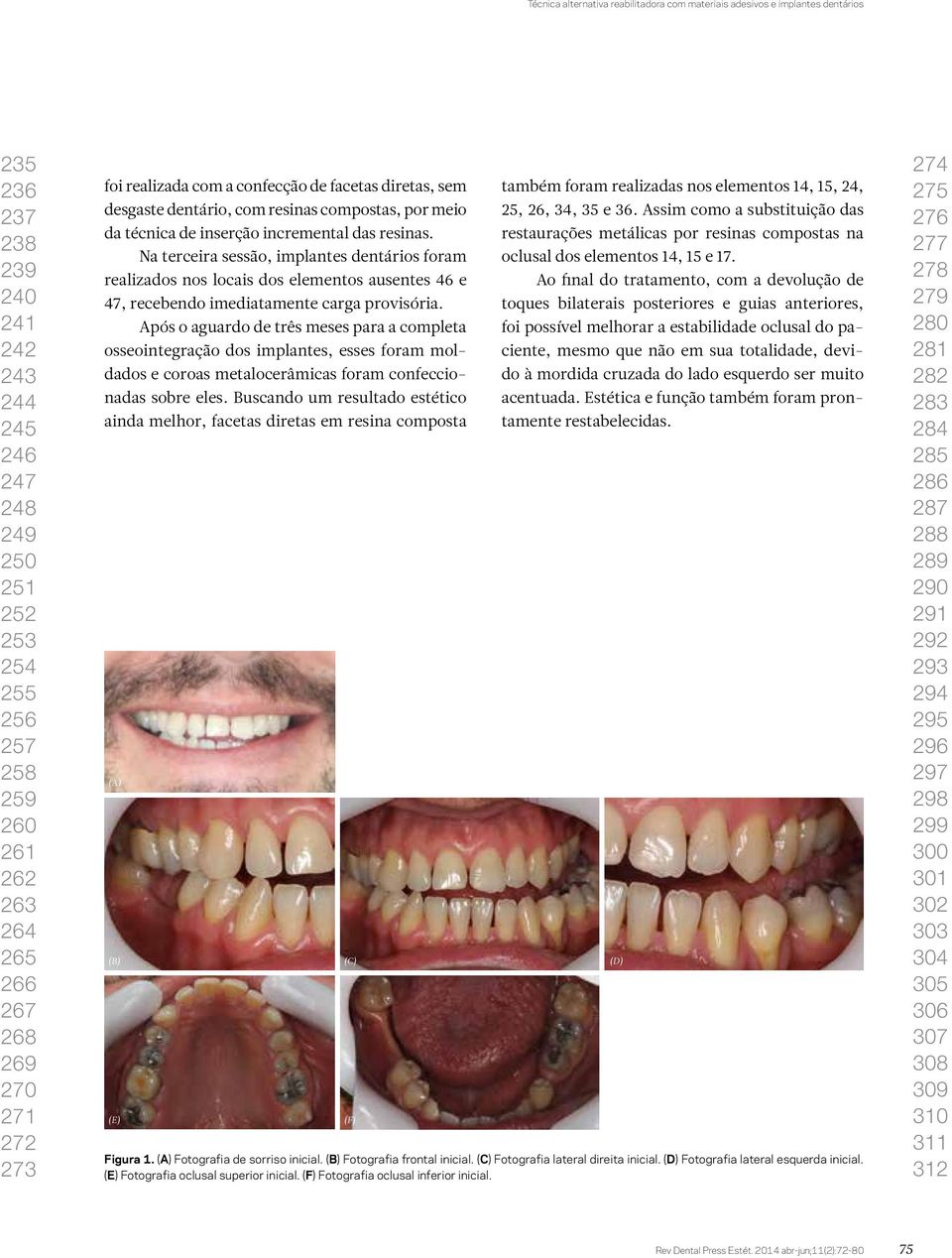 Na terceira sessão, implantes dentários foram realizados nos locais dos elementos ausentes 46 e 47, recebendo imediatamente carga provisória.