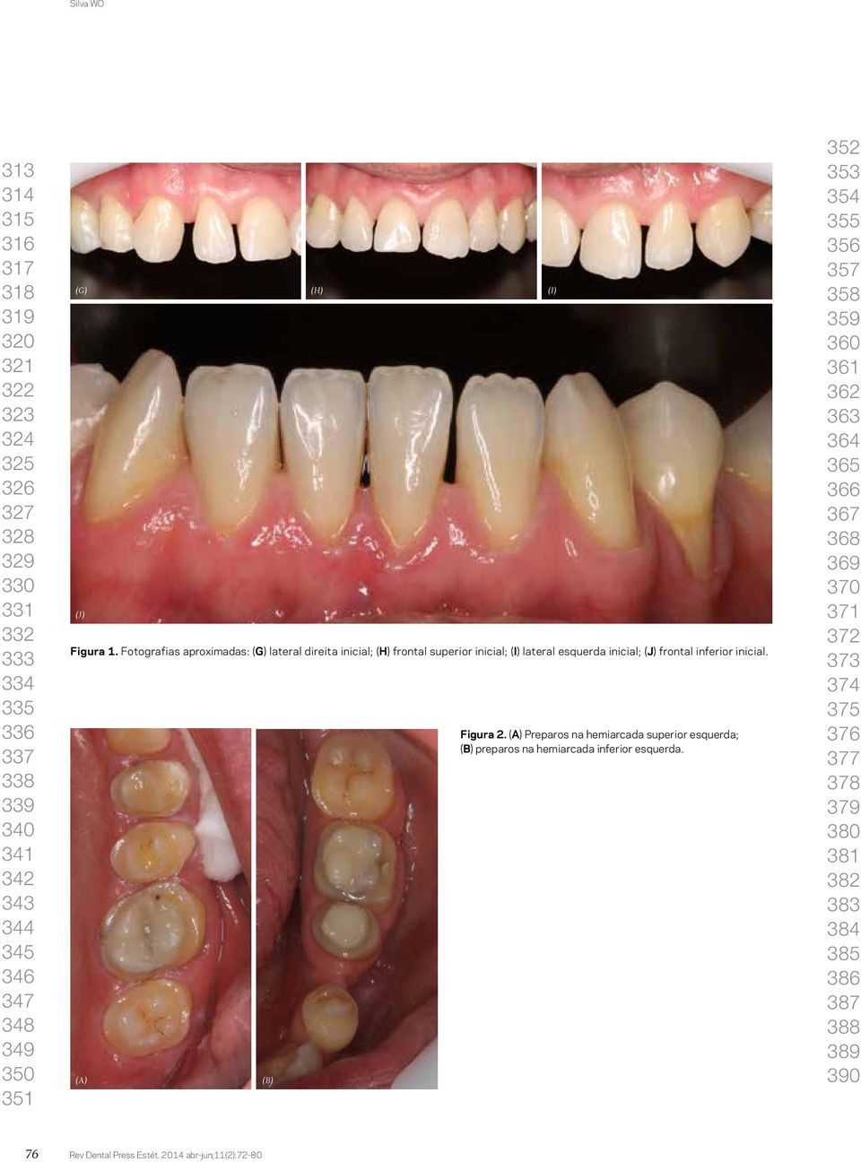 Fotografias aproximadas: (G) lateral direita inicial; (H) frontal superior inicial; (I) lateral esquerda inicial; (J) frontal inferior inicial.