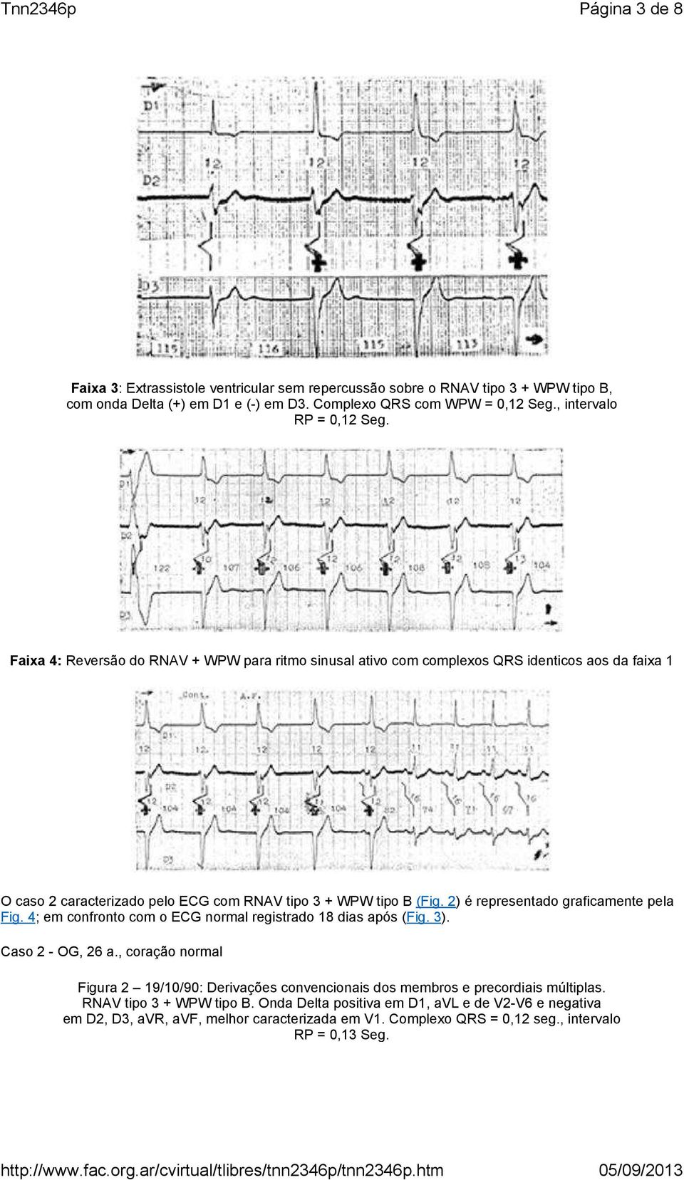 Faixa 4: Reversão do RNAV + WPW para ritmo sinusal ativo com complexos QRS identicos aos da faixa 1 O caso 2 caracterizado pelo ECG com RNAV tipo 3 + WPW tipo B (Fig.