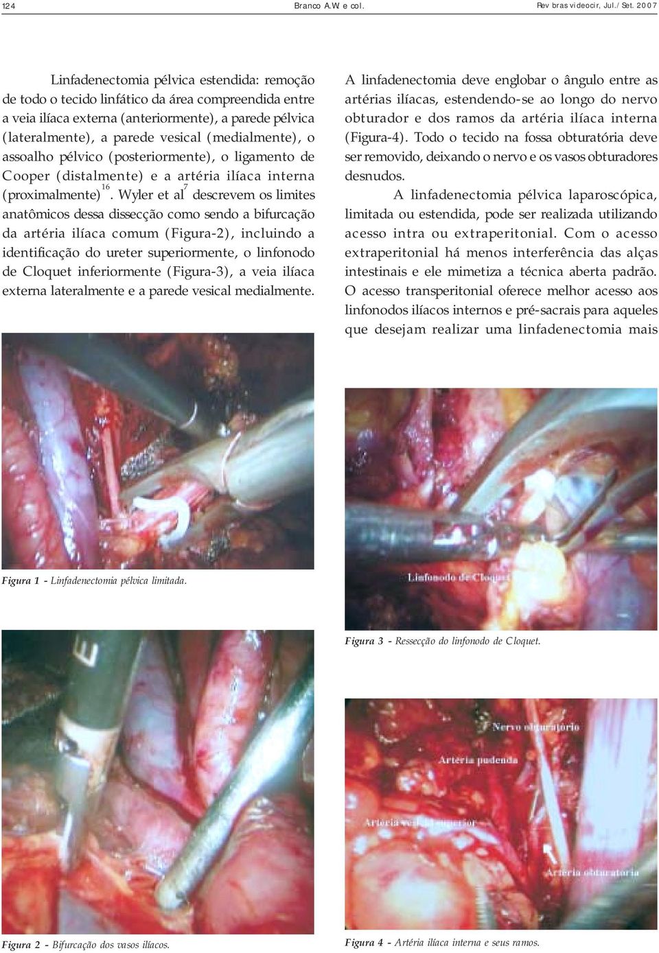 (medialmente), o assoalho pélvico (posteriormente), o ligamento de Cooper (distalmente) e a artéria ilíaca interna (proximalmente) 16.